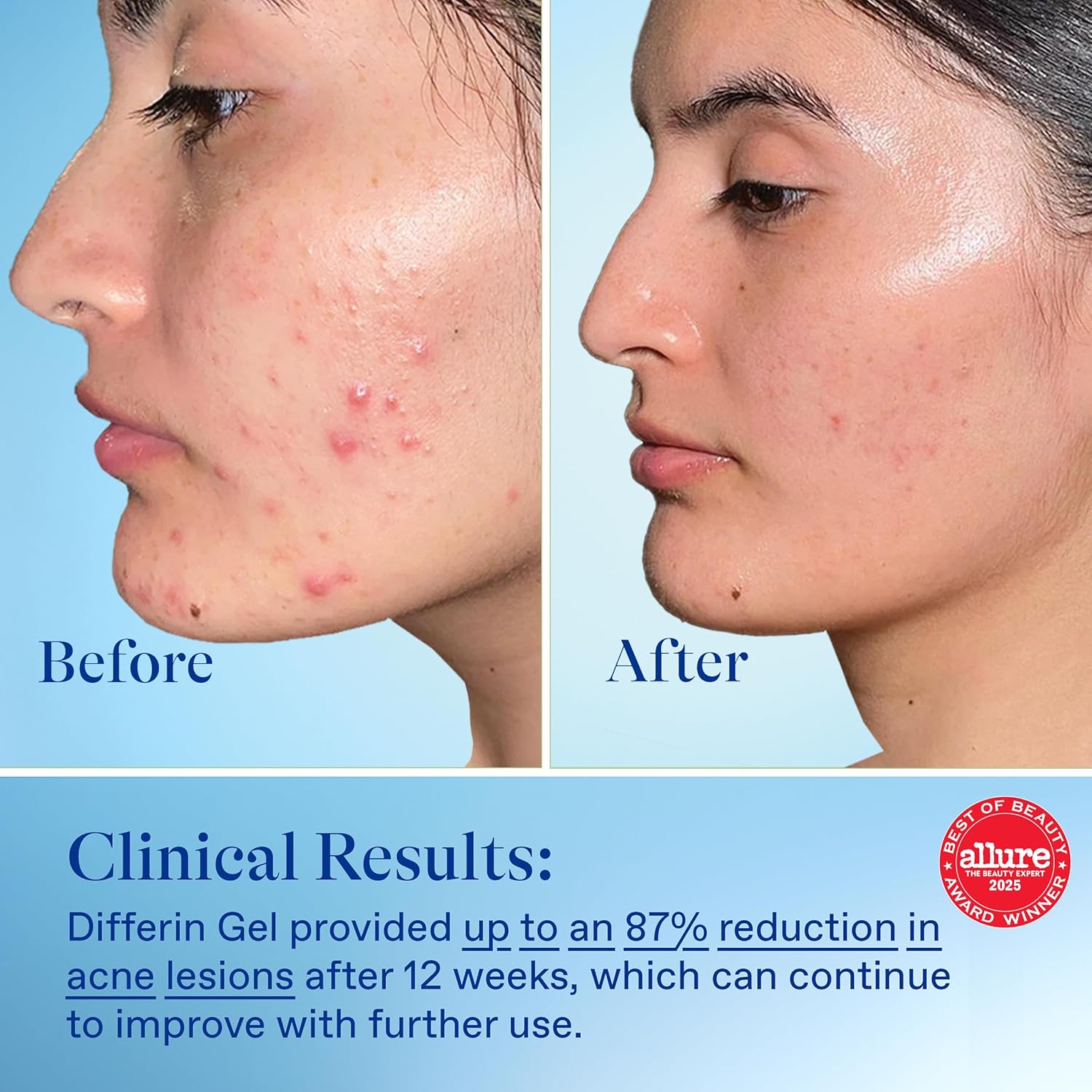 디페린 아다팔렌 여드름 치료 젤 15g – 트러블 개선 레티노이드 젤